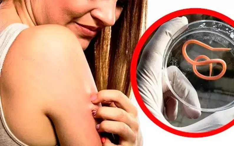 Vücuttaki parazitlerden dolayı kaşıntı ve tahriş