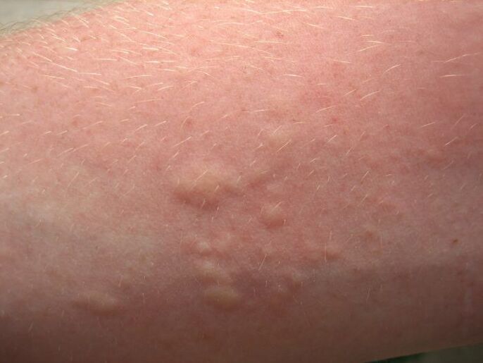 kaşıntılı alerjik deri döküntüleri askariazisin semptomları olabilir